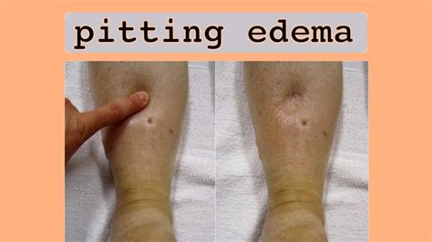 Pitting Edema: Symptoms, Causes, And When To See A Doctor, 59% OFF