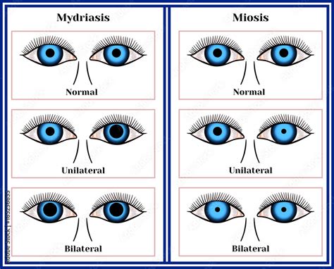 Mydriasis - expansion of a pupil. Miosis - narrowing of a pupil. Stock Vector | Adobe Stock