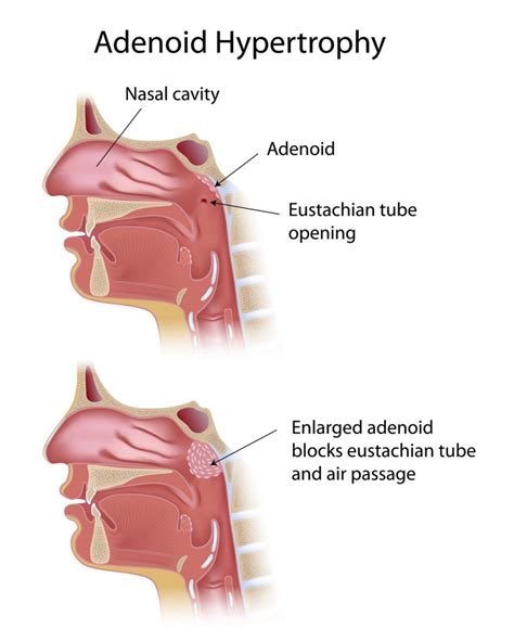 Adenoid and Adenoidectomy - Otolaryngology Specialists of North Texas