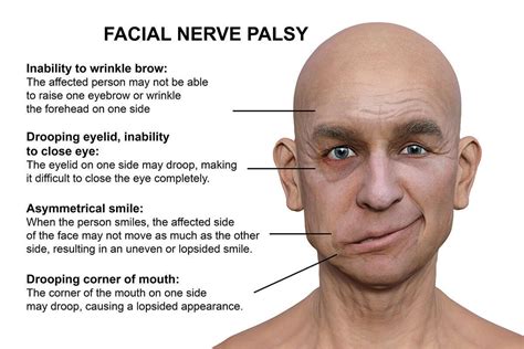 Bells Palsy Ideas Bells Palsy Facial Nerve Health | The Best Porn Website