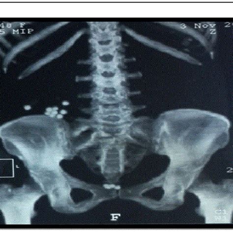 a and 1b: CT scanning showing RT Pyonephrosis with multiple stones and ...