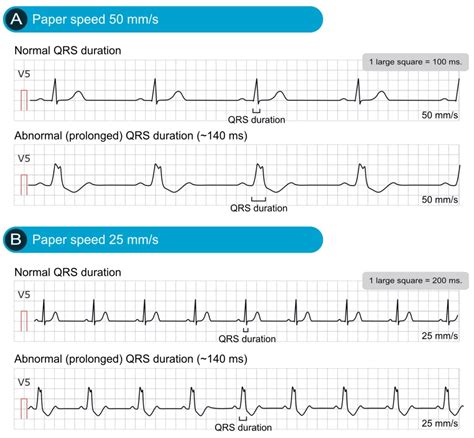 Killer ECG Patterns: Part • LITFL • ECG Library, 52% OFF