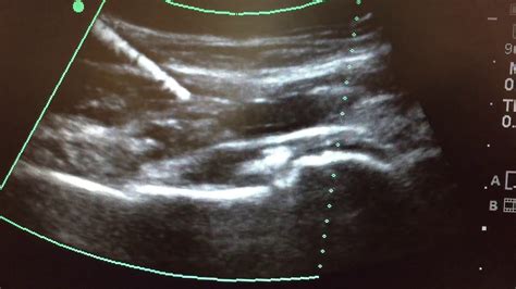 Hip Joint Injection Ultrasound