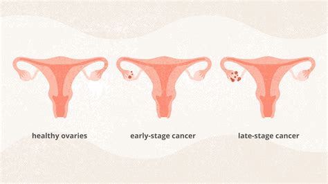 The Stages of Ovarian Cancer and What They Mean