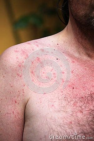 Rash Or Sun Allergy Stock Photography - Image: 14962602