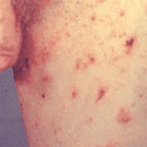 What are the symptoms of scabies? – All Stop FAQ