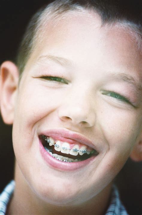 How Much are Braces for Kids? - Braces Or Invisalign?.com