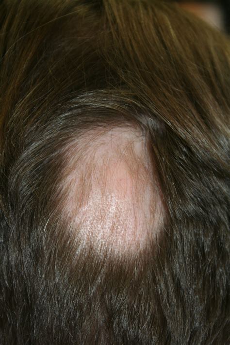 Alopecia-Hair loss Dermatologie und Venerologie in Zürich und Kreuzlingen -Vicky Bekou