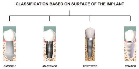 Types of Dental Implants by Sizes, Procedures and Materials