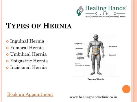 Epigastric Hernia Types