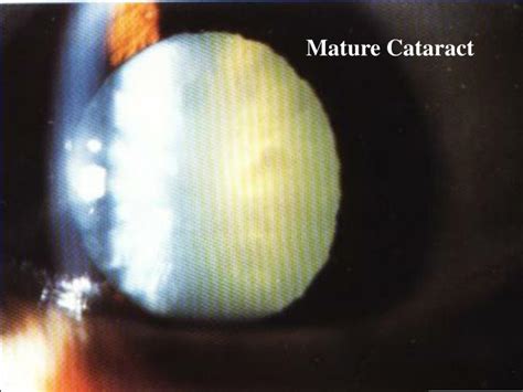 PPT - Cataract PowerPoint Presentation - ID:3930717