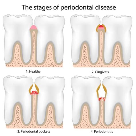 Signs & Symptoms of Periodontal Disease