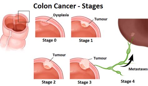 Colon Cancer - Causes, Diagnosis and Treatment