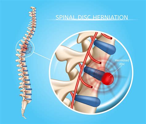 Disc Herniation | Aptiva Health