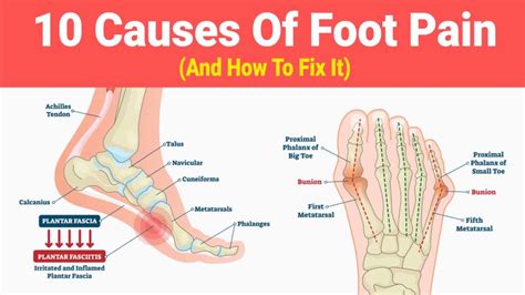 Foot Pain Chart Side