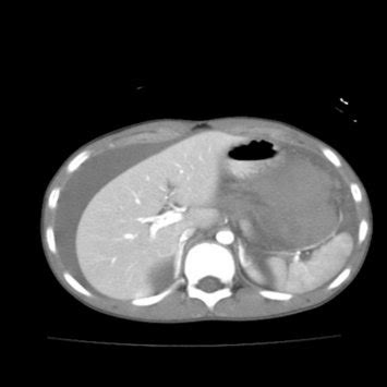 CT scan of the abdomen showing hemoperitoneum with large hematoma in... | Download Scientific ...