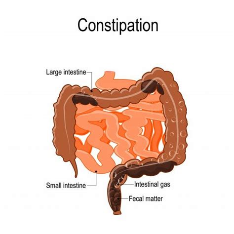 Constipation Treatment Atlanta | Piedmont Colorectal Associates