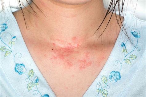 Skin Allergy: Identifying 3 Common Skin Rashes