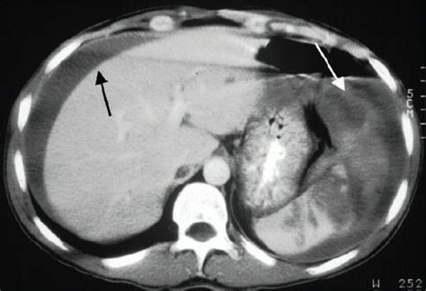 Hemoperitoneum - Gastrointestinal - Medbullets Step 2/3