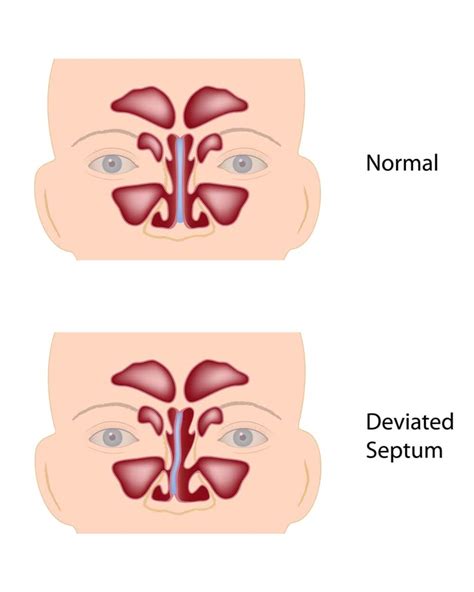 Deviated Septum - Sutton Place Dental Associates