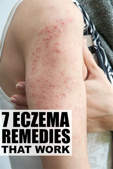 What causes eczema flare ups - indianlockq