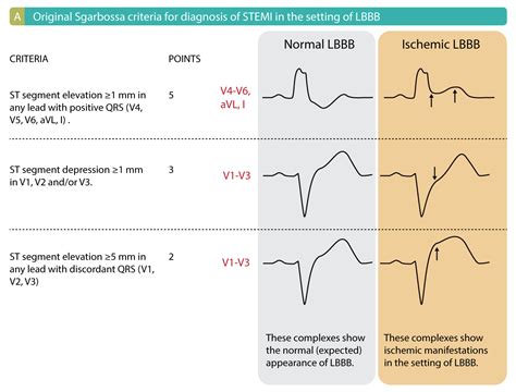 Left bundle branch block (LBBB) in acute myocardial infarction: the Sgarbossa criteria ...