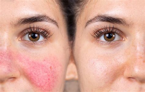 Is Rosacea a Lifelong Problem?: Los Gatos Dermatology: Cosmetic Dermatologists