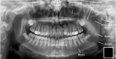 Dentistry lectures for MFDS/MJDF/NBDE/ORE: Radiographic Anatomy of Facial Bones and Mandible ...