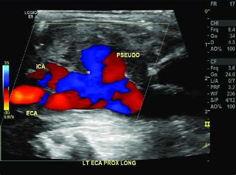 Carotid Arteries Ultrasound