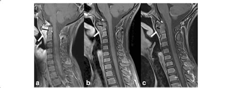 MRI of cervical spine (patient #8)(T1 TSE FS sagittal with a contrast... | Download Scientific ...