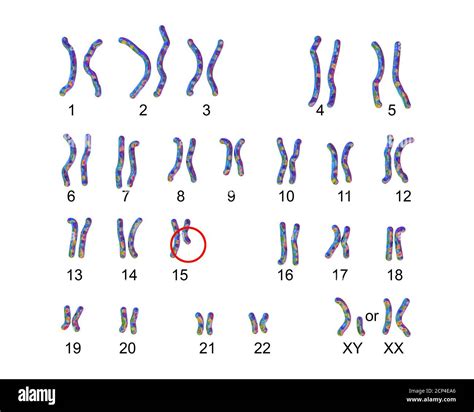 Karyotype of Prader-Willi syndrome, computer illustration. This is a genetic disorder caused by ...