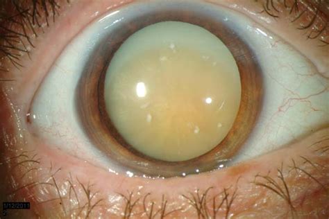 Morgagnian Cataract. EyeRounds.org - Ophthalmology - The University of Iowa