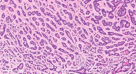 Adenoid Histology