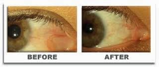 Medical Treatment Pictures-for Better Understanding: Pterygium Excision ...