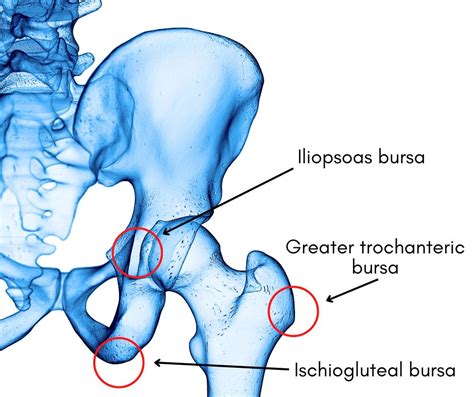 Hip Bursitis: Symptoms and Diagnosis