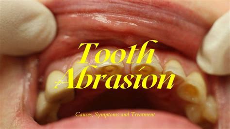 Tooth Abrasion: Causes, Symptoms And Treatment [Complete Explanation ...