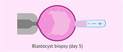 Trophoectoderm biopsy on day 5