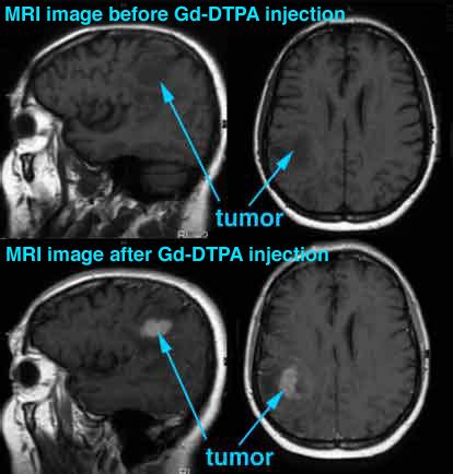 Gadolinium Neutron Capture Therapy (GdNCT) – Pupa Gilbert Research ...