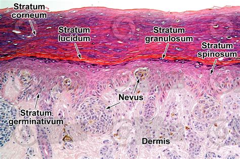 Compound Nevus Histology