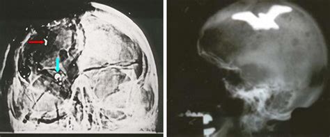 EXCLUSIVE: JFK autopsy 'bullet fragment' X-ray was faked, denounced as ...