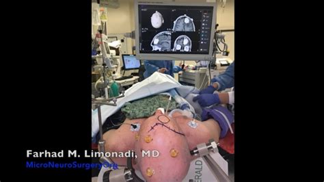 Brain Surgery Removal Of A Large Meningioma Brain Tumor – Otosection