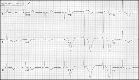 ECG Learning Center - An introduction to clinical electrocardiography