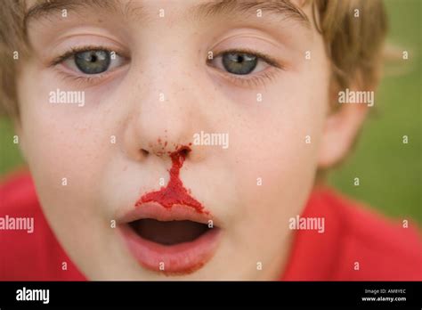 boy with bleeding nose Stock Photo: 4959211 - Alamy