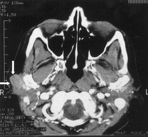 Parotid CT showing an intraparotid lymph node swelling. | Download ...