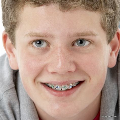 Braces Colors Ideas For Boys