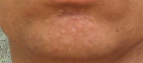 Raised Bumps On Chin...hypertrophic Scar? - Hypertrophic (raised) scars - Acne.org Community