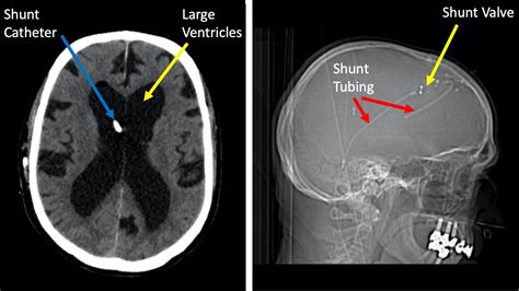 Hydrocephalus Shunt Mri