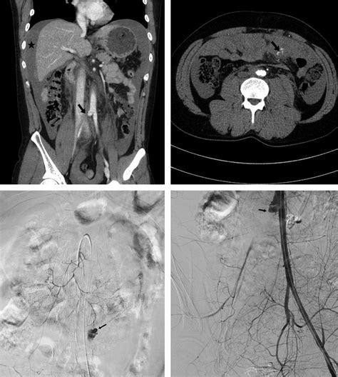 (A) Abdomen CT scan showing hemoperitoneum (star), a short-segmental... | Download Scientific ...