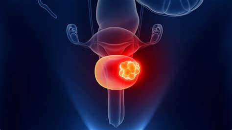 Novel Drug for Advanced Urothelial Cancer: Enfortumab Vedotin