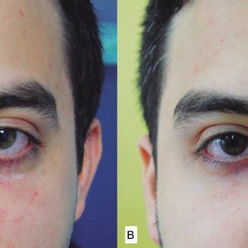 A: Color photograph showing the bilateral lower scleral show before HA... | Download Scientific ...